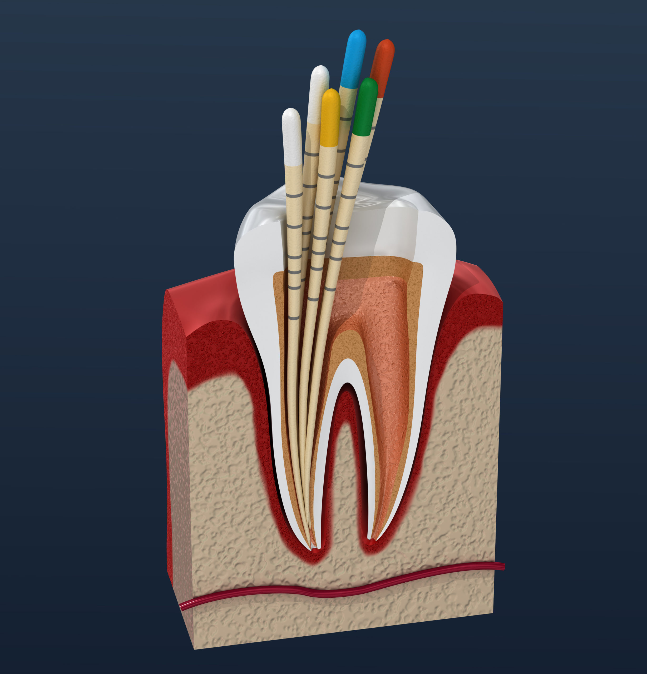 Wurzelentzündung Zahn